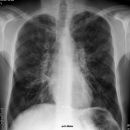 Cystische Fibrose
