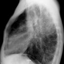 Cystische Fibrose