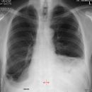 Enterothorax