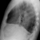 Enterothorax