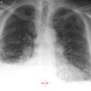 Lungenfibrose DD atypische Infiltrate