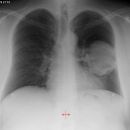 Plattenepithel Ca