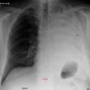 Pneumonektomie