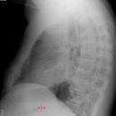 Pneumonektomie