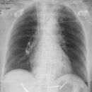 Pneumopericard