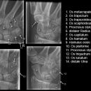 Scaphoid.jpg