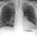 Trachea Y Stent